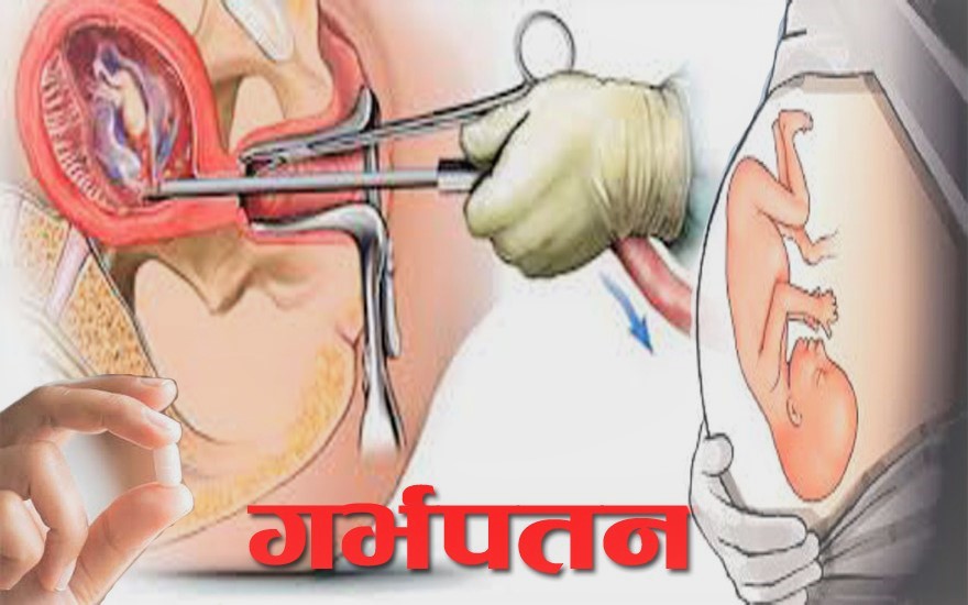 डोटीमा एघार महिनामा एक हजारले गरे गर्भपतन
