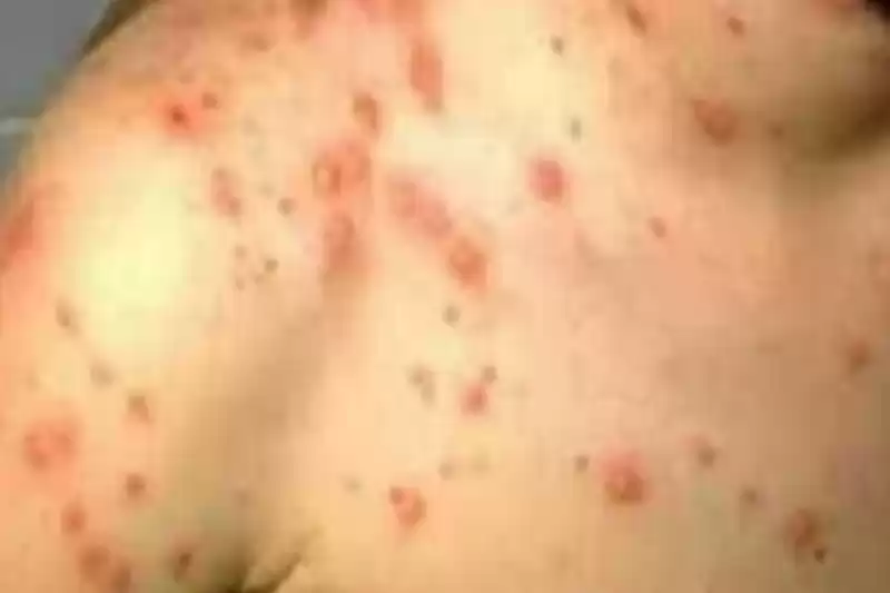 बढ्न थाले स्क्रबटाइफस रोगका बिरामी