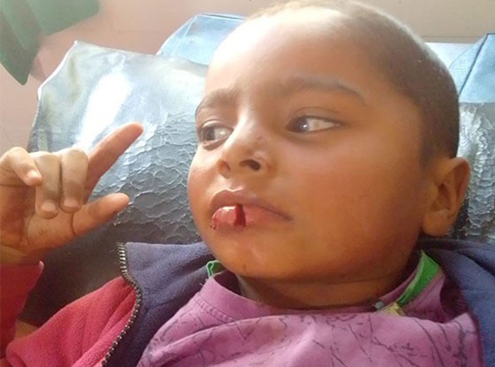 कुकुरको टोकाईबाट २ बालक घाइते